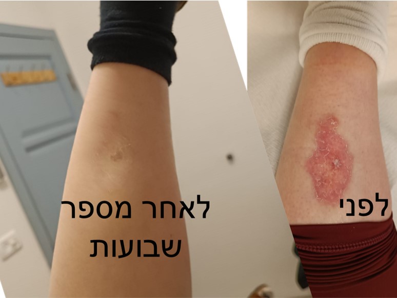 טיפול בפצעי סוכרת