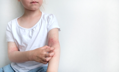 אסתמה של העור Atopic Dermatitis